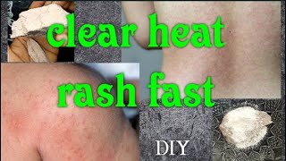 How to get rid of HEAT RASHES fast at home within 3 days| DIY heat rash remedy