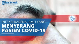 Mengenal Jamur Hitam (Mucormycosis), Infeksi akibat Jamur Mucor Memiliki Tingkat Kematian 50 Persen