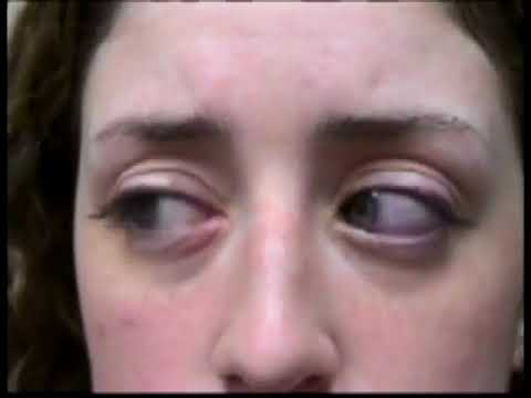 6.9. Friedreich's Ataxia - Cerebellar Ataxia [Spring Video Atlas]