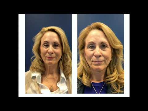 Botulinum toxin and selective neurectomy