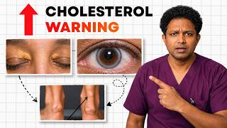 Are These 4 Skin Signs Hiding High Cholesterol? Don't Ignore Them!