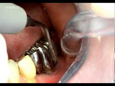 Furcations with H2L and H2R tips
