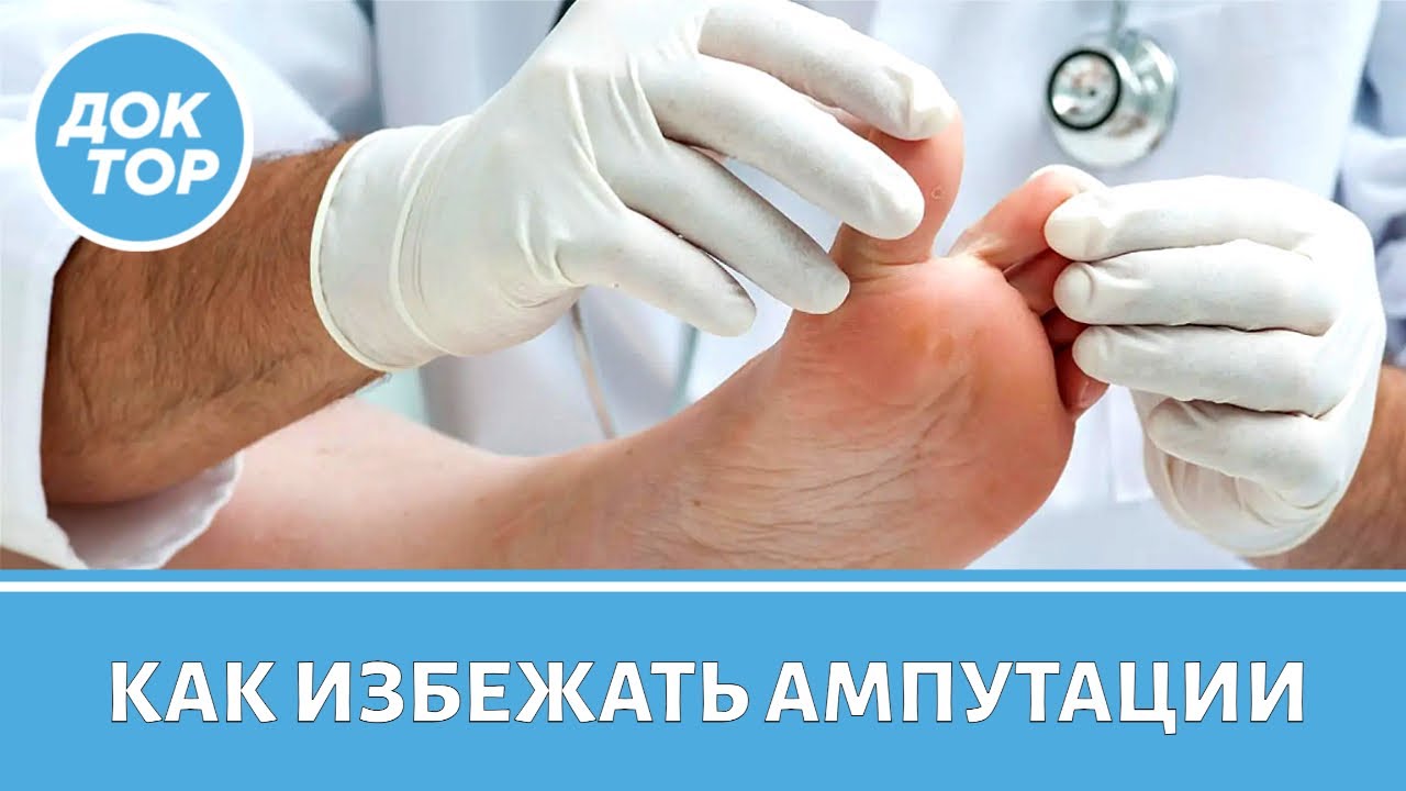 Как не пропустить первые признаки развития диабетической стопы