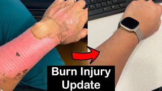 Long Term Healing Progress Of Second Degree Burns (3 Year Update)