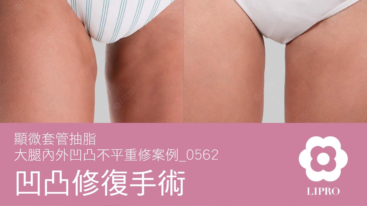 凹凸修復手術｜顯微套管抽脂｜大腿內外凹凸不平重修案例_0562
