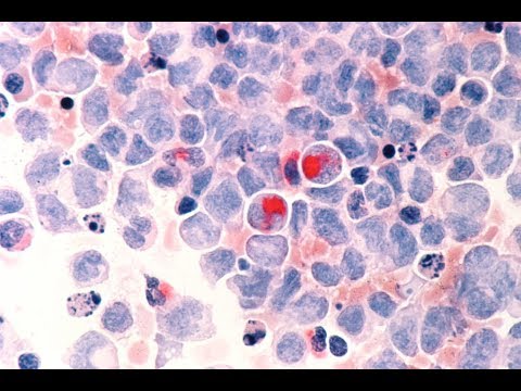 Improving outcomes for myeloid cancers