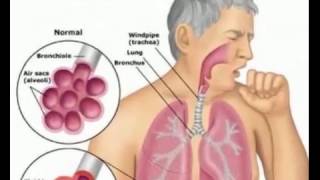 interview sur la journée mondiale pneumonie 