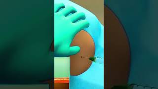 Download lagu How Lumbar Puncture Surgery Is Done? Medical 3D Animation. #brainaneurysm #hospital #followers mp3