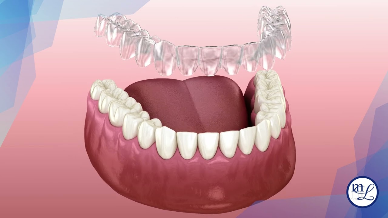 Allineatori trasparenti - Un Sorriso Perfetto senza rinunciare all'Estetica