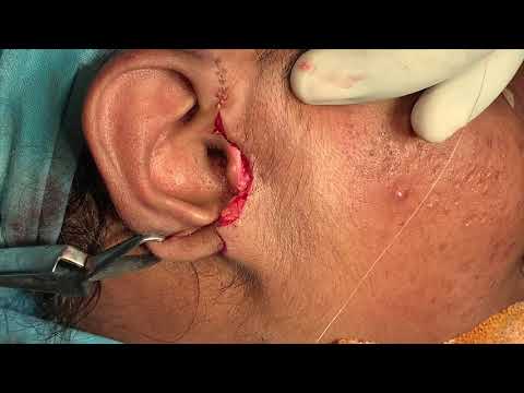 Mini Facelift Surgery To Tighten Loose Facial Skin
