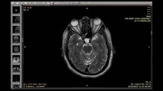 8-MV PLUS (Multi-nodular Vacuolating Posterior Fossa Lesion of Unknown Significance)