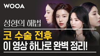 [성형의 해법] 코 수술에 관한 모든 것 완벽 정리❗| 직선코 직반코 버선코 직반버선코
