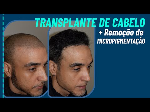 Miniatura do depoimento: Depoimento e Resultado Pós-Operatório