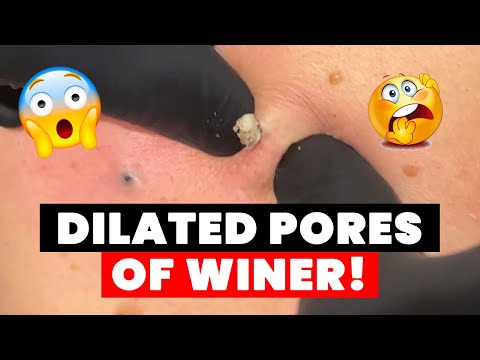 DILATED PORES OF WINER!