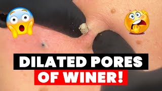 DILATED PORES OF WINER!