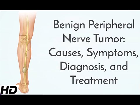 Pernicious Anemia Causes Signs and Symptoms Diagnosis and Treatment