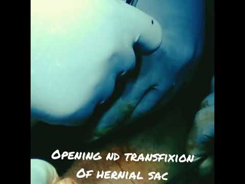 Inguinal Hernia Surgery
