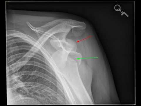Bilateral shoulder dislocation
