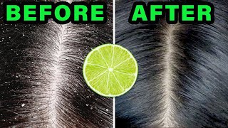 How to REMOVE DANDRUFF in 10 minutes USING LEMON JUICE!