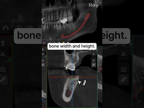 SMARTDent : 5D Tutorial #3-1. Bone Measurement Before Implant Placement