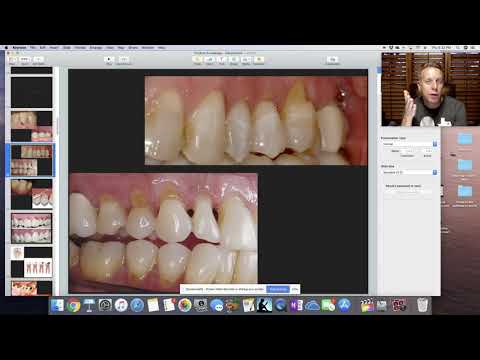 Class V Lesions. Education for dental staff.