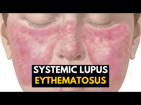 Systemic Lupus Eythematosus (SLE), Causes, Signs and Symptoms, Diagnosis and Treatment.