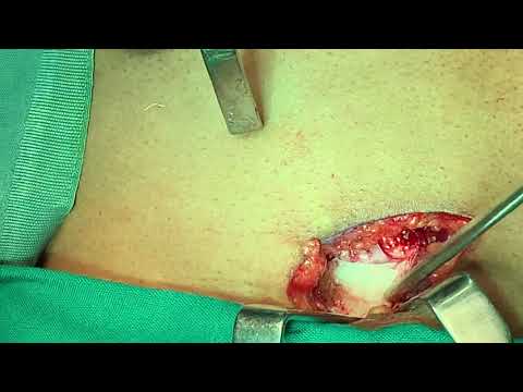 How To Harvest A Rib? Reconstructive Nose Job