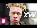 Why I'm Proud of My Albinism | Living Differently