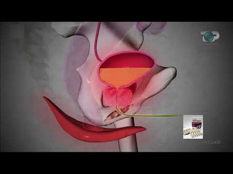 Hipokrati - Prostata - Çfarë është Prostatiti dhe Zmadhimi i Prostatës – 20 Qershor 2020
