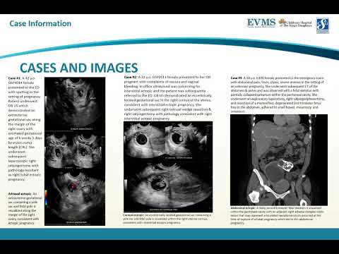 Thumbnail image of video presentation for Imaging Spectrum of Ectopic Pregnancy