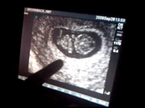 2009.09.28 - Baby Brownback (First Heartbeat).3GP