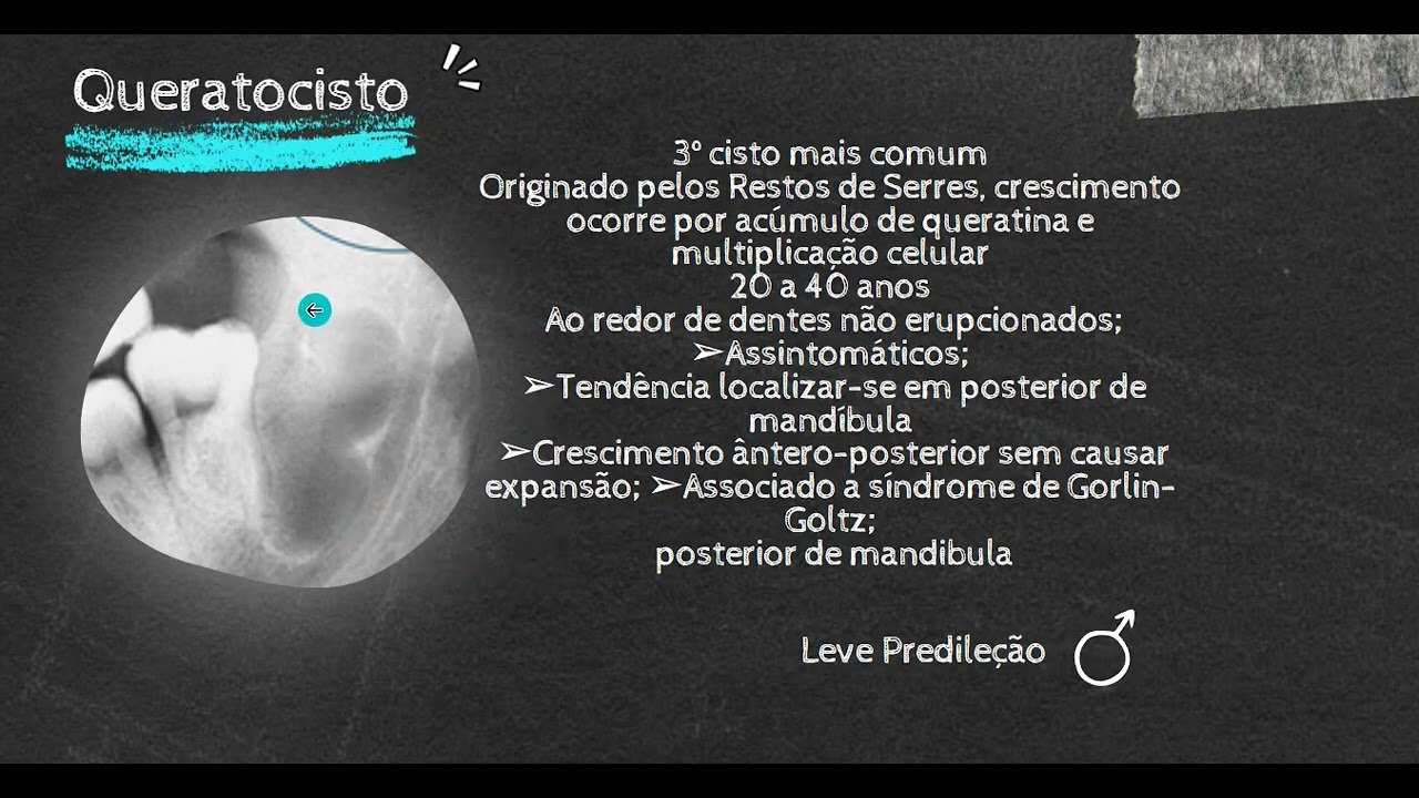 Cistos Odontogênicos de Desenvolvimento