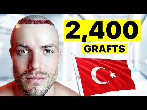 I Got A Hair Transplant In Turkey | Surgeon Reacts
