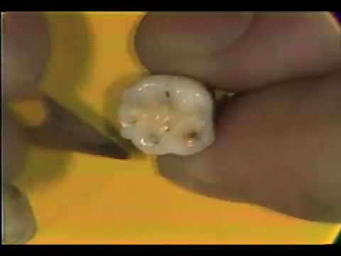 Mandibular Molars Review