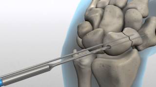Acutrak 2.0 screw for a Scaphoid Hand Fracture