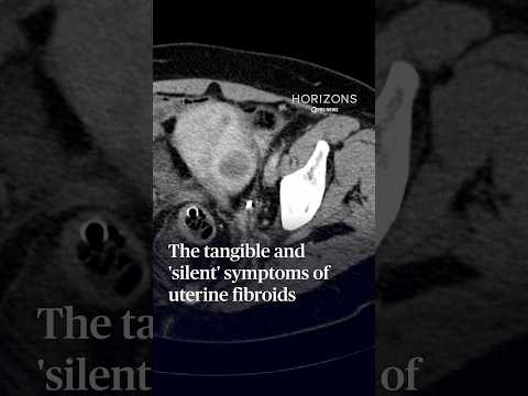 The tangible and 'silent' symptoms of uterine fibroids