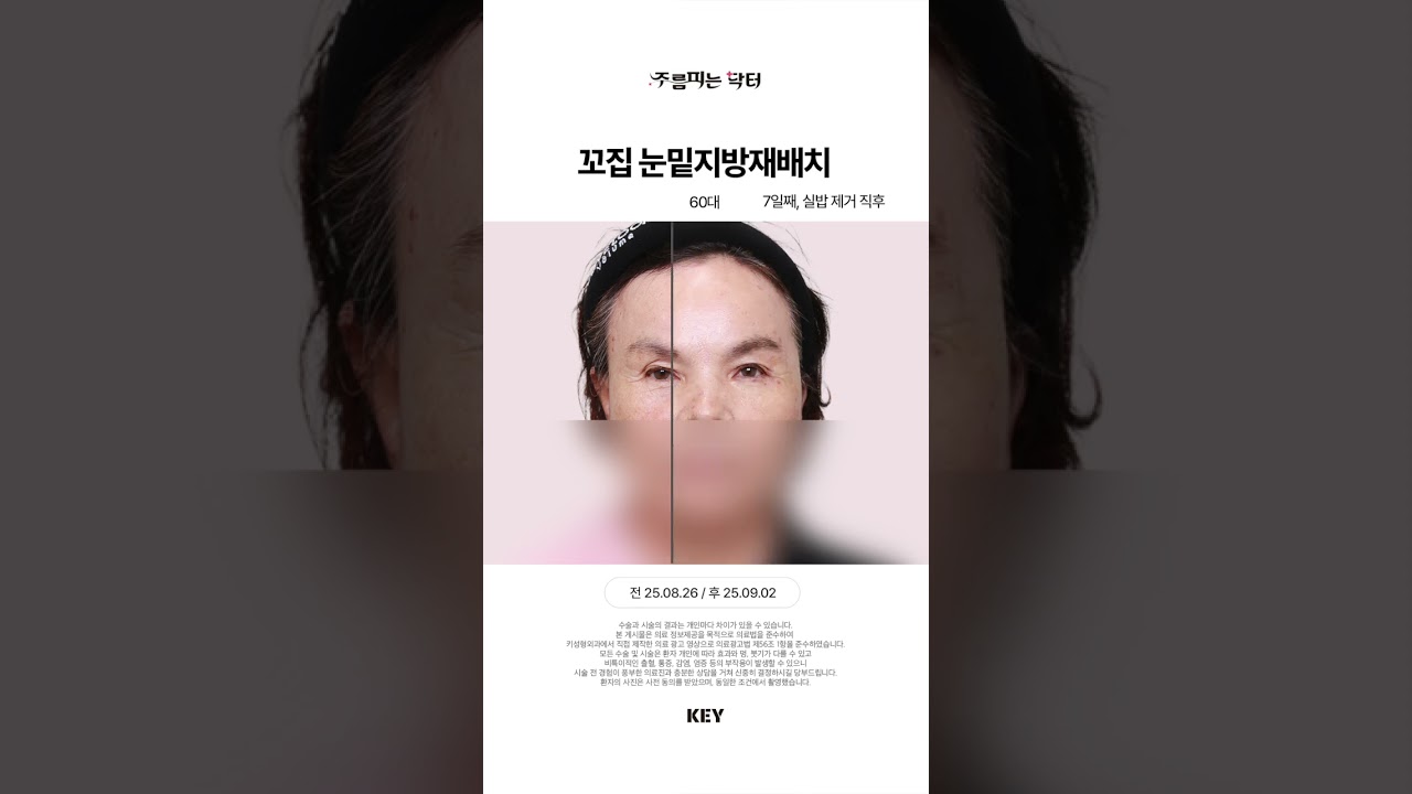 60대 꼬집눈밑지방재배치 7일후