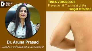 White Patches on Skin. Is it TINEA VERSICOLOR - Is it Fungal ? -Dr.Aruna Prasad | Doctors