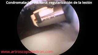 Artroscopia de Rodilla: Condromalacia Rotuliana