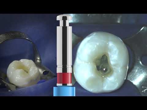 VDW Dental · VDW.ROTATE™ Basis Sequenz (klinisches Video)