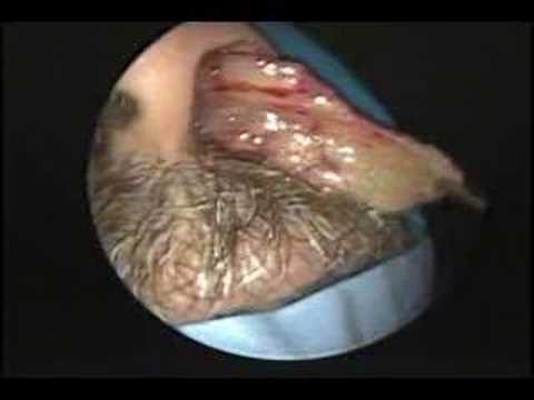 Intraductal papilloma breast surgery