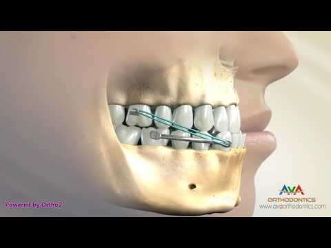 Orthodontic Treatment for Underbite or Crossbite - Carriere Appliance
