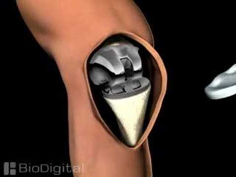 3D Medical Animation of a Knee Replacement