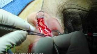 How Nose Surgery is Performed – Ear Cartilage Harvest – Nose Job