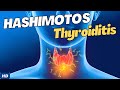 Hashimoto's Disease: Causes, Symptoms and Treatment