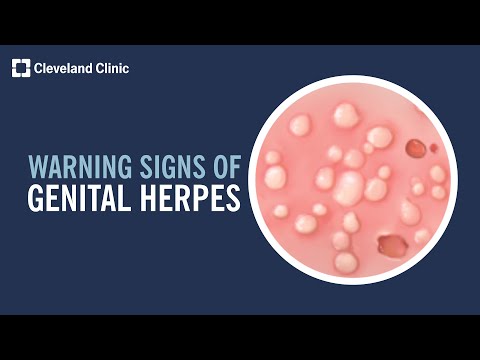 5 Warning Signs of Genital Herpes