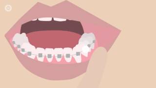 How To Deal With Braces Discomfort - What