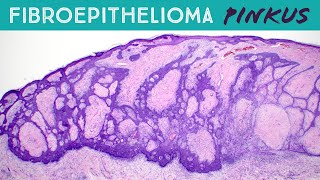 Fibroepithelioma of Pinkus (basal cell carcinoma subtype vs hair follicle tumor) dermpath pathology