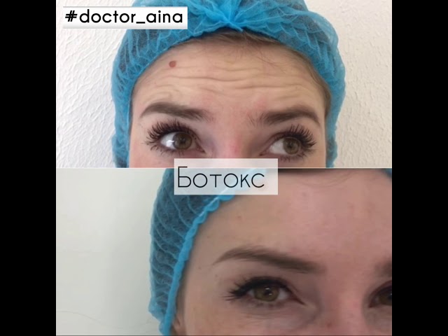 Коррекция морщин ботоксом