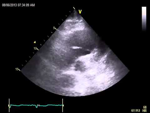 Aortic Aneurysm and Dissection